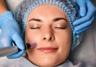 Microneedling