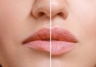 Lippen Formverbesserung