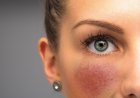 Rosacea & Couperose – Wenn die Haut rot sieht: Ganzheitliche Hilfe bei Gefäßschwächelnden Hautbildern