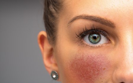 Rosacea & Couperose – Wenn die Haut rot sieht: Ganzheitliche Hilfe bei Gefäßschwächelnden Hautbildern