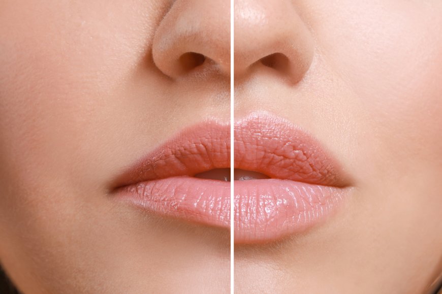 Lippen Formverbesserung