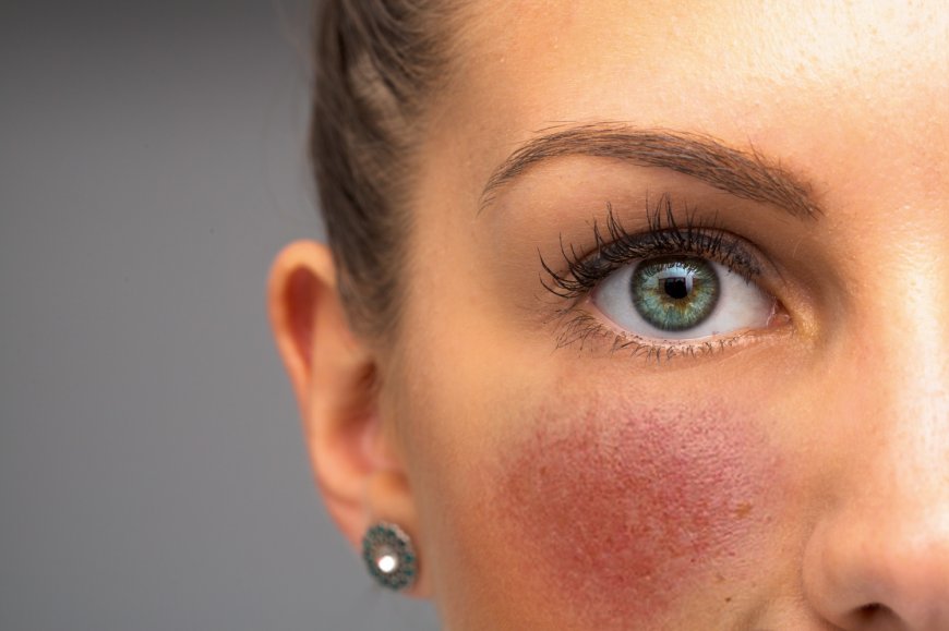 Rosacea & Couperose – Wenn die Haut rot sieht: Ganzheitliche Hilfe bei Gefäßschwächelnden Hautbildern